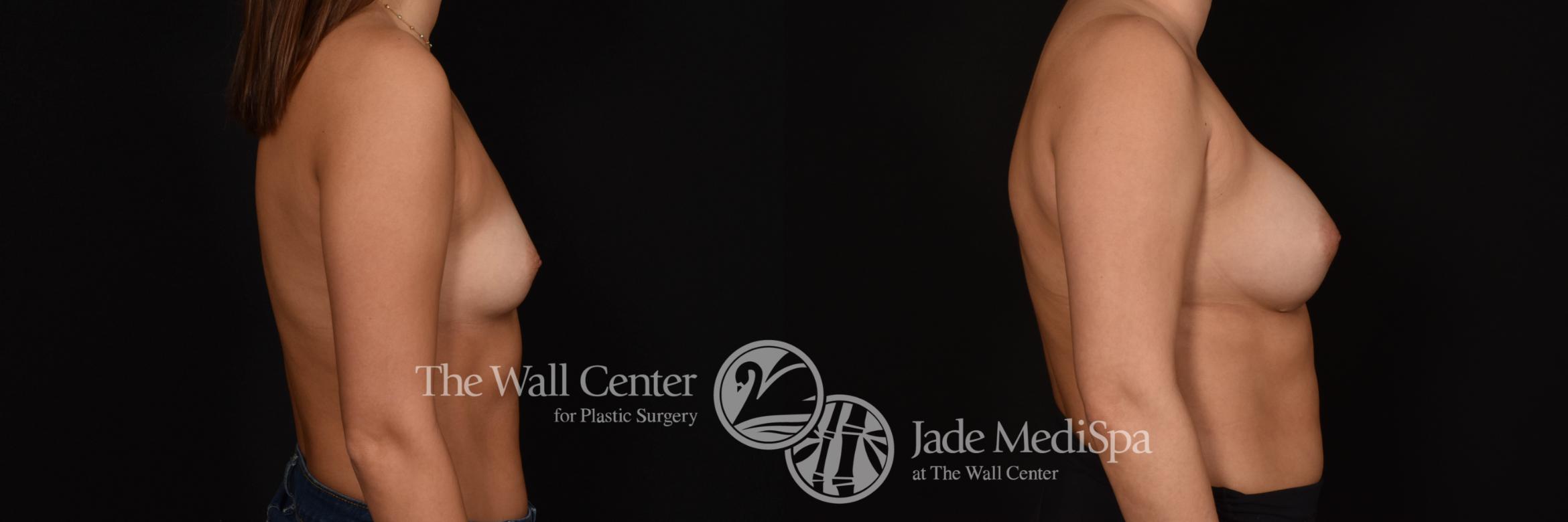 Before & After Breast Augmentation Case 1032 Right Side View in Shreveport, LA