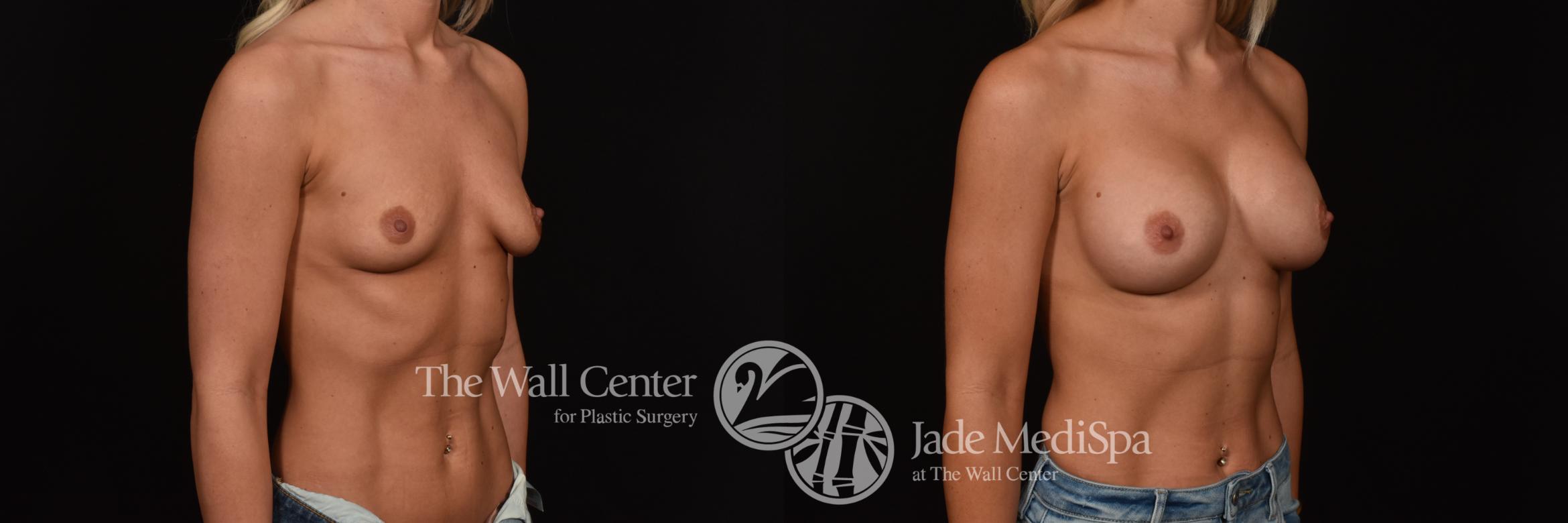 Before & After Breast Augmentation Case 1040 Right Oblique View in Shreveport, LA