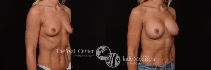Before & After Breast Augmentation Case 1040 Right Oblique View in Shreveport, LA