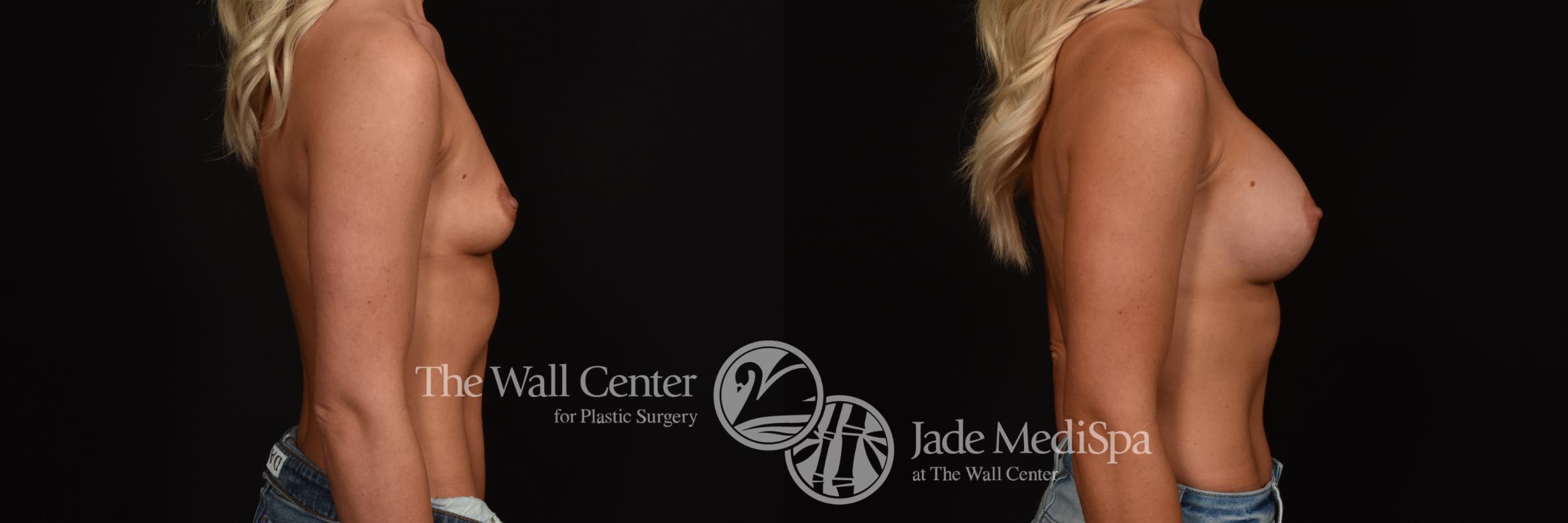 Before & After Breast Augmentation Case 1040 Right Side View in Shreveport, LA