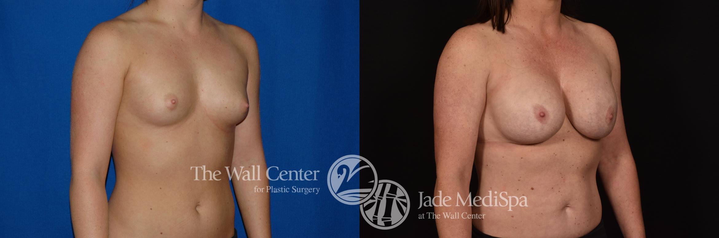 Before & After Breast Augmentation Case 1050 Right Oblique View in Shreveport, LA
