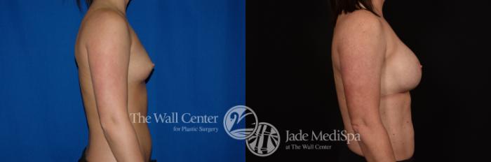 Before & After Breast Augmentation Case 1050 Right Side View in Shreveport, LA