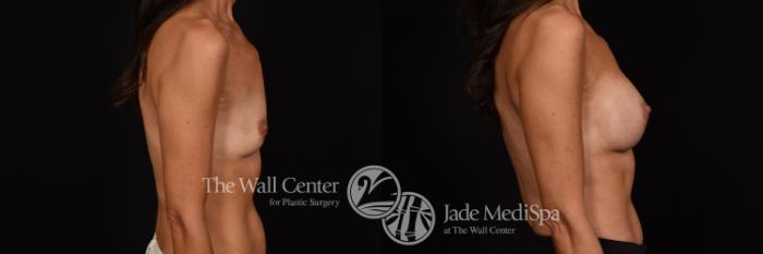 Before & After Breast Augmentation Case 1057 Right Side View in Shreveport, LA