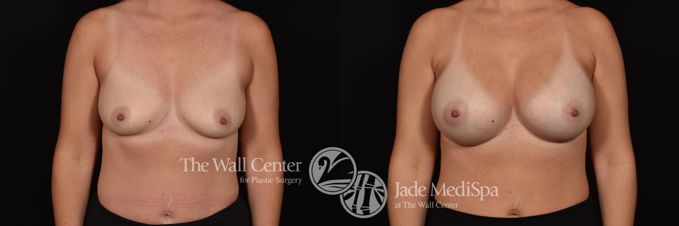 Before & After Breast Augmentation Case 1063 Front View in Shreveport, LA