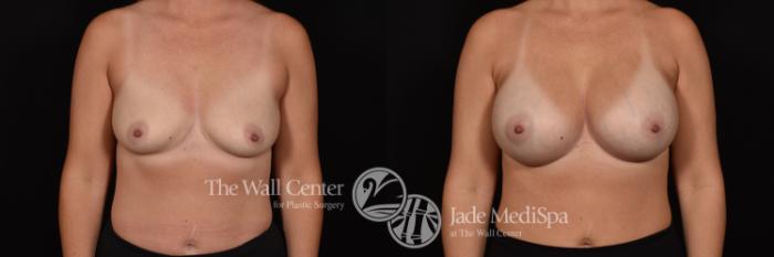 Before & After Breast Augmentation Case 1063 Front View in Shreveport, LA