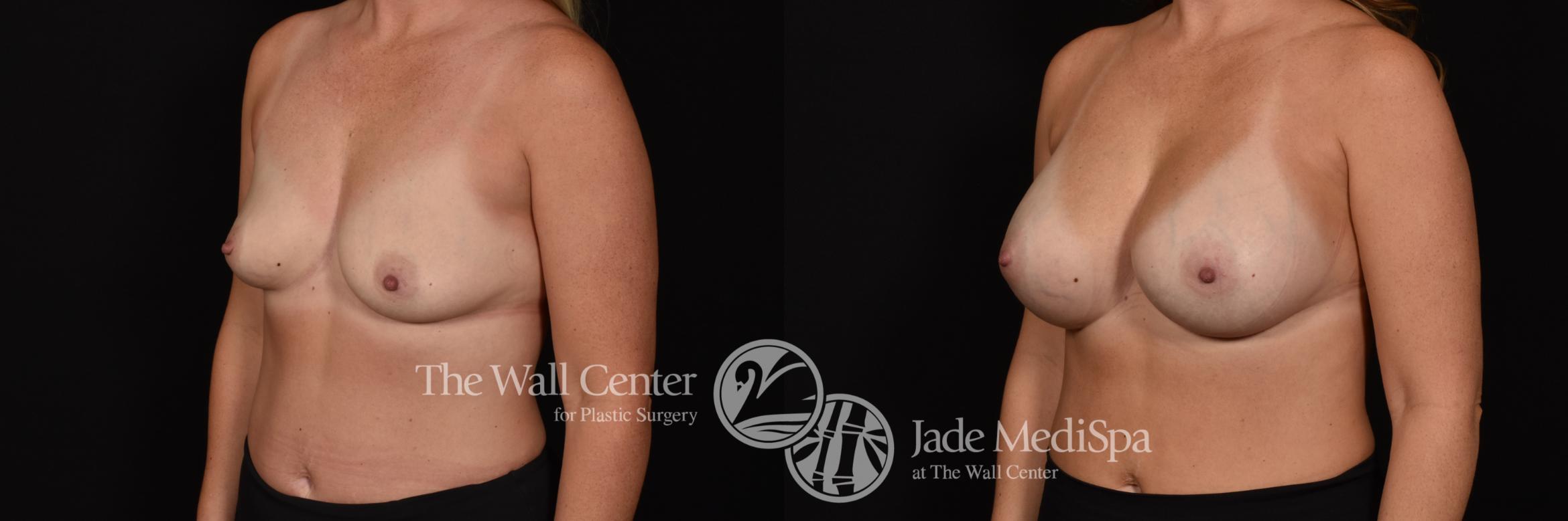 Before & After Breast Augmentation Case 1063 Left Oblique View in Shreveport, LA