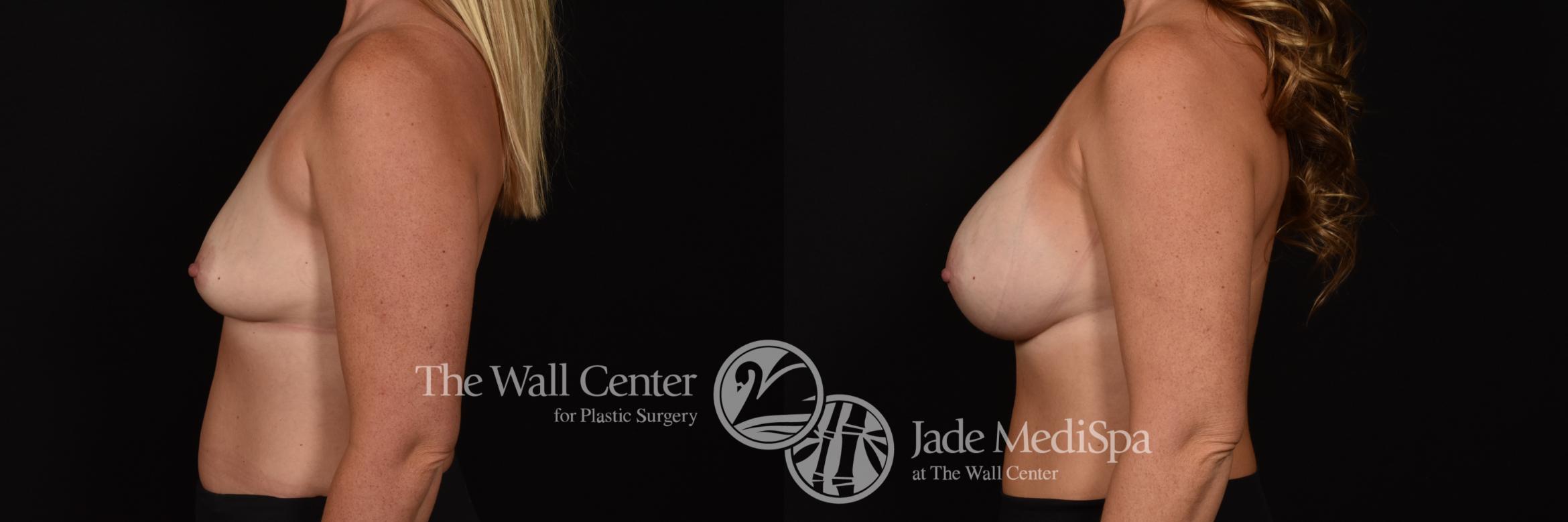 Before & After Breast Augmentation Case 1063 Left Side View in Shreveport, LA