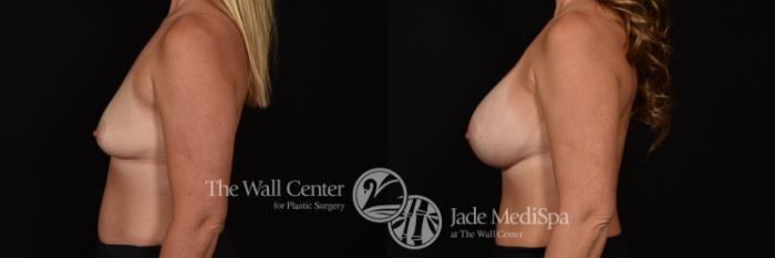 Before & After Breast Augmentation Case 1063 Left Side View in Shreveport, LA