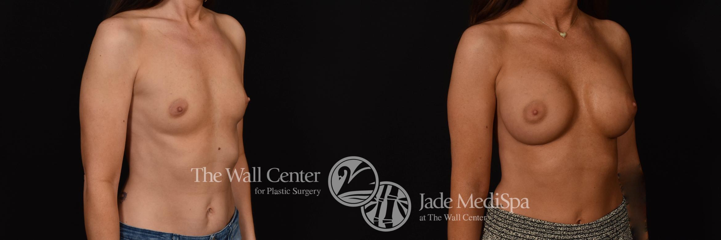 Before & After Breast Augmentation Case 1069 Right Oblique View in Shreveport, LA