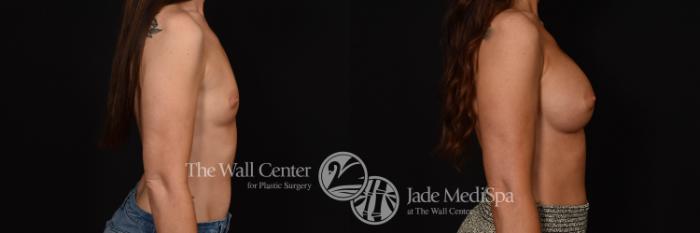 Before & After Breast Augmentation Case 1069 Right Side View in Shreveport, LA