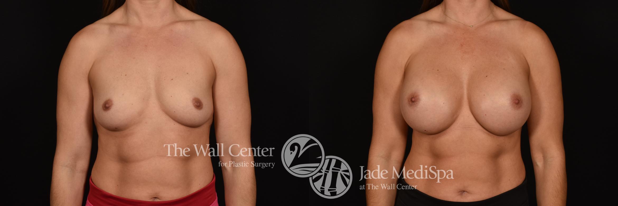 Before & After Breast Augmentation Case 1072 Front View in Shreveport, LA