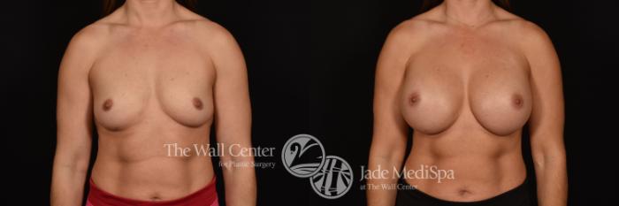Before & After Breast Augmentation Case 1072 Front View in Shreveport, LA