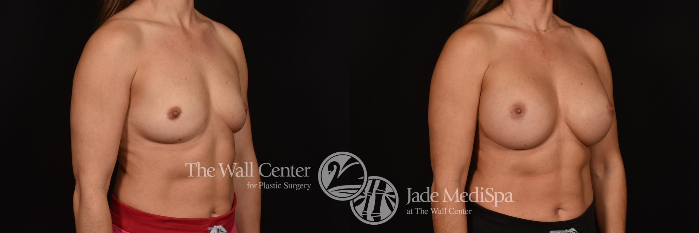 Before & After Breast Augmentation Case 1072 Right Oblique View in Shreveport, LA