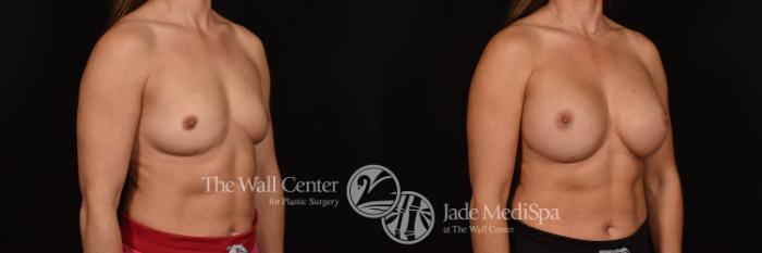 Before & After Breast Augmentation Case 1072 Right Oblique View in Shreveport, LA