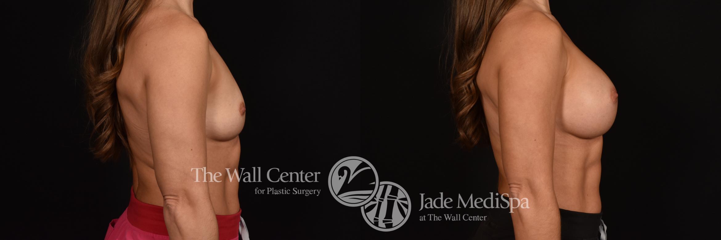 Before & After Breast Augmentation Case 1072 Right Side View in Shreveport, LA