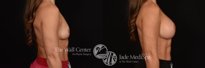 Before & After Breast Augmentation Case 1072 Right Side View in Shreveport, LA