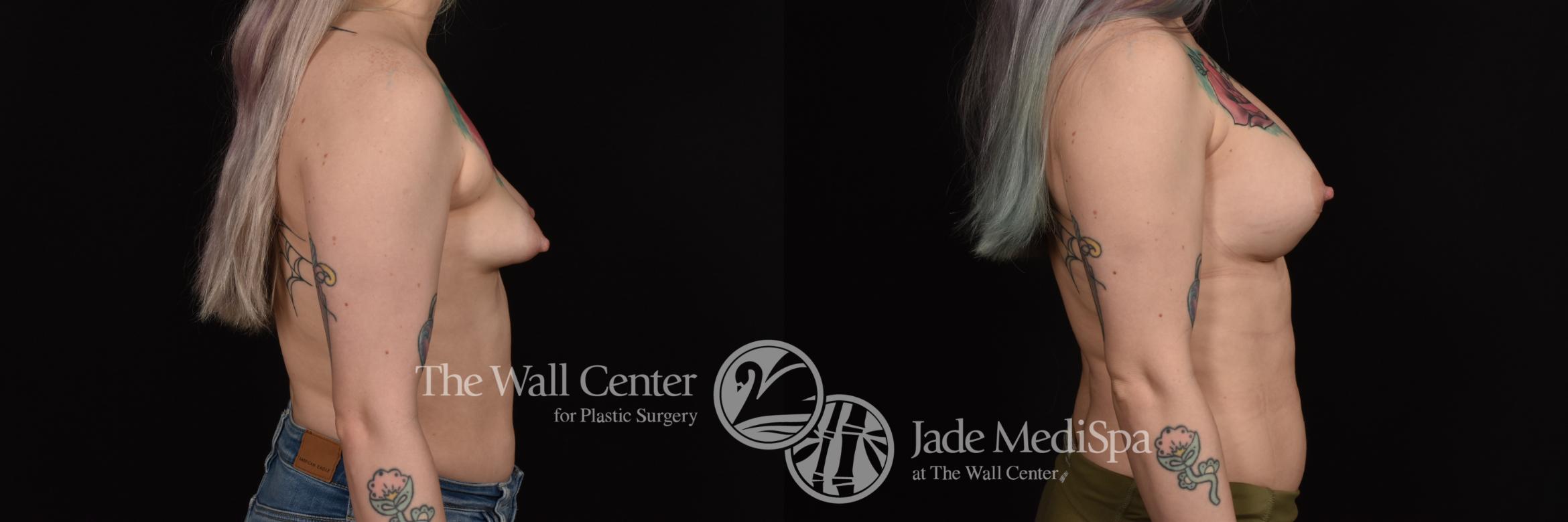 Before & After Breast Augmentation Case 1073 Right Side View in Shreveport, LA