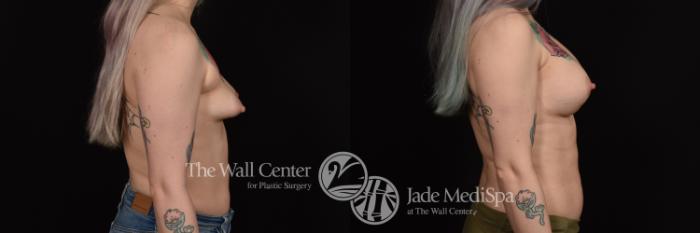 Before & After Breast Augmentation Case 1073 Right Side View in Shreveport, LA
