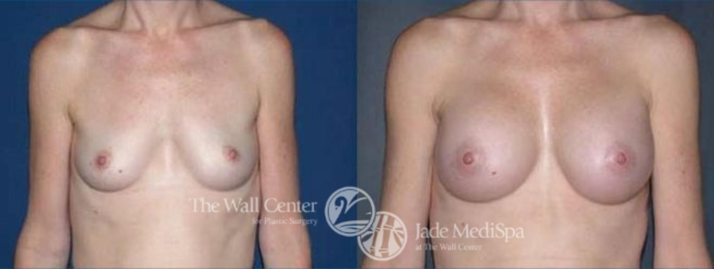 Before & After Breast Augmentation Case 108 View #1 View in Shreveport, LA