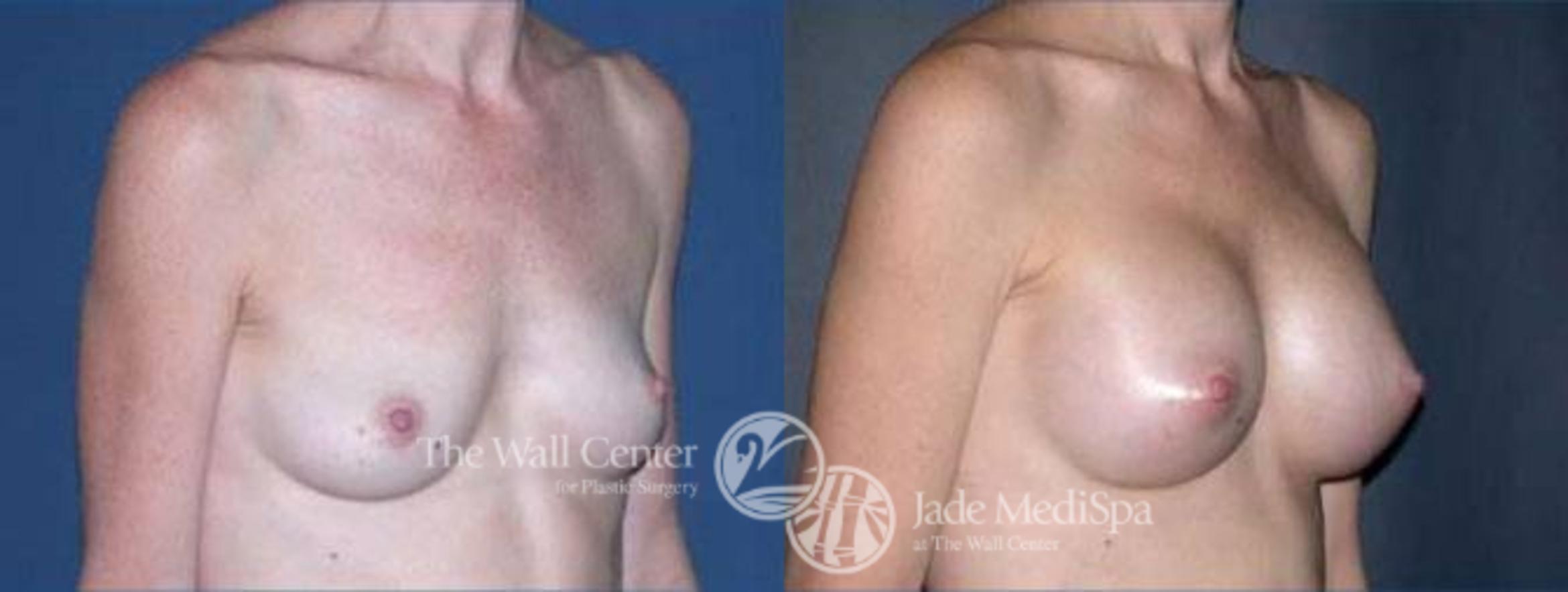 Before & After Breast Augmentation Case 108 View #2 View in Shreveport, LA