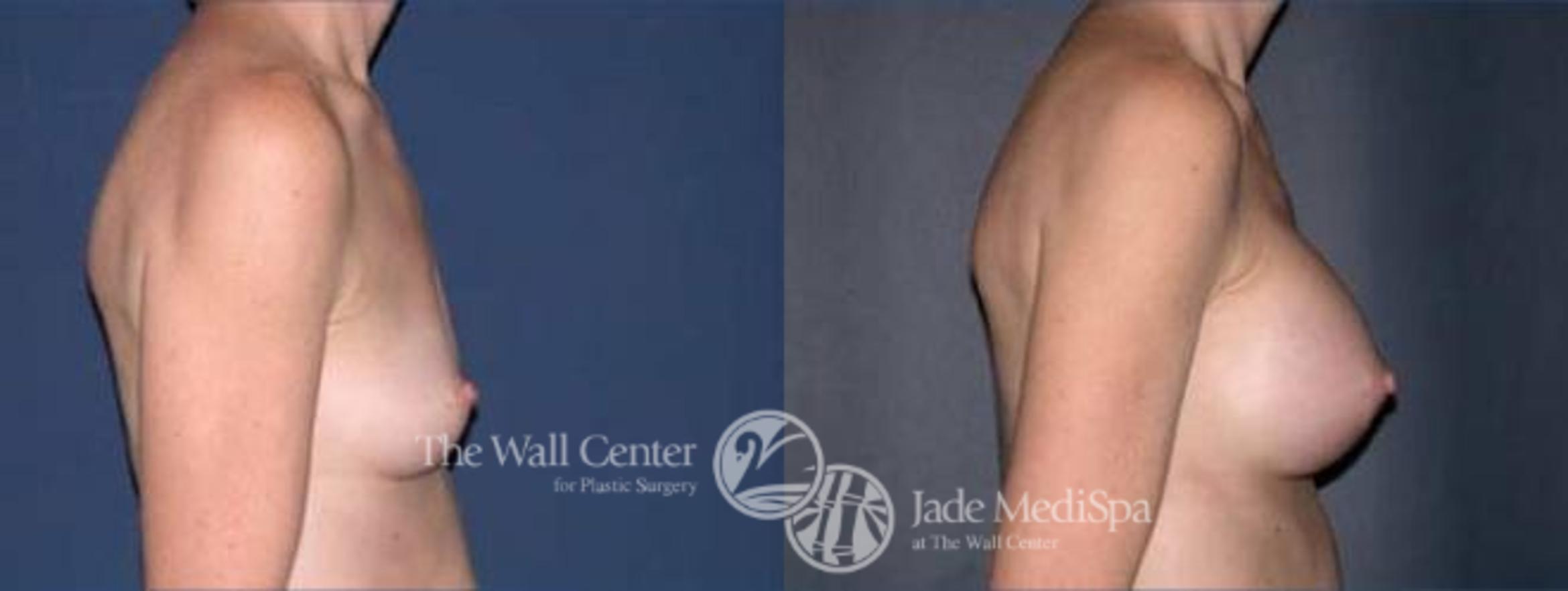 Before & After Breast Augmentation Case 108 View #3 View in Shreveport, LA