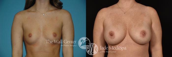 Before & After Breast Augmentation Case 1083 Front View in Shreveport, LA