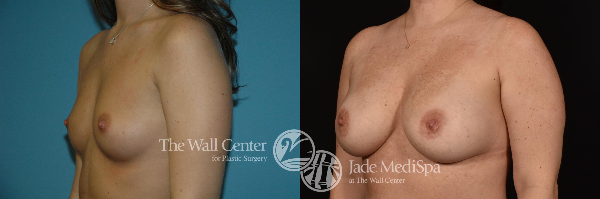 Before & After Breast Augmentation Case 1083 Left Oblique View in Shreveport, LA