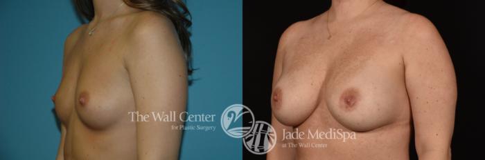 Before & After Breast Augmentation Case 1083 Left Oblique View in Shreveport, LA