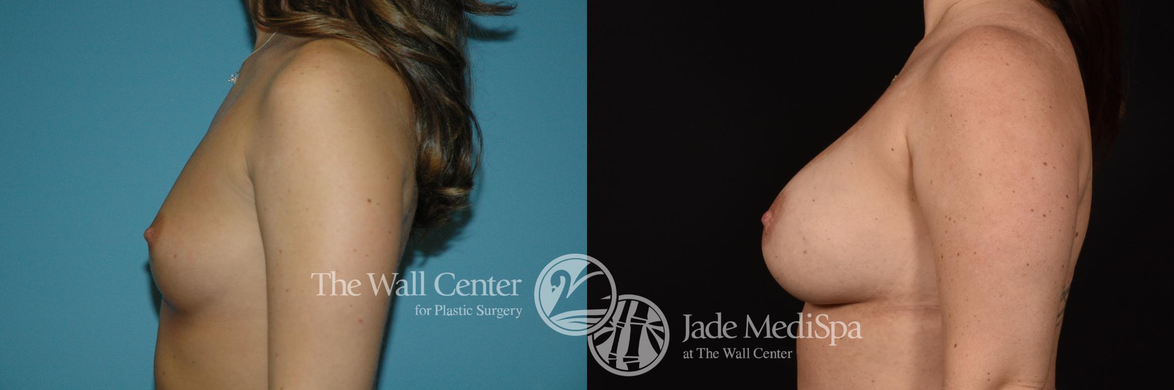 Before & After Breast Augmentation Case 1083 Left Side View in Shreveport, LA