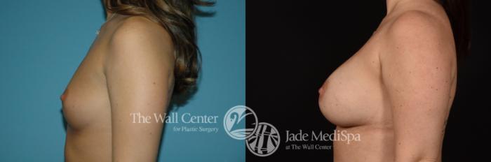 Before & After Breast Augmentation Case 1083 Left Side View in Shreveport, LA