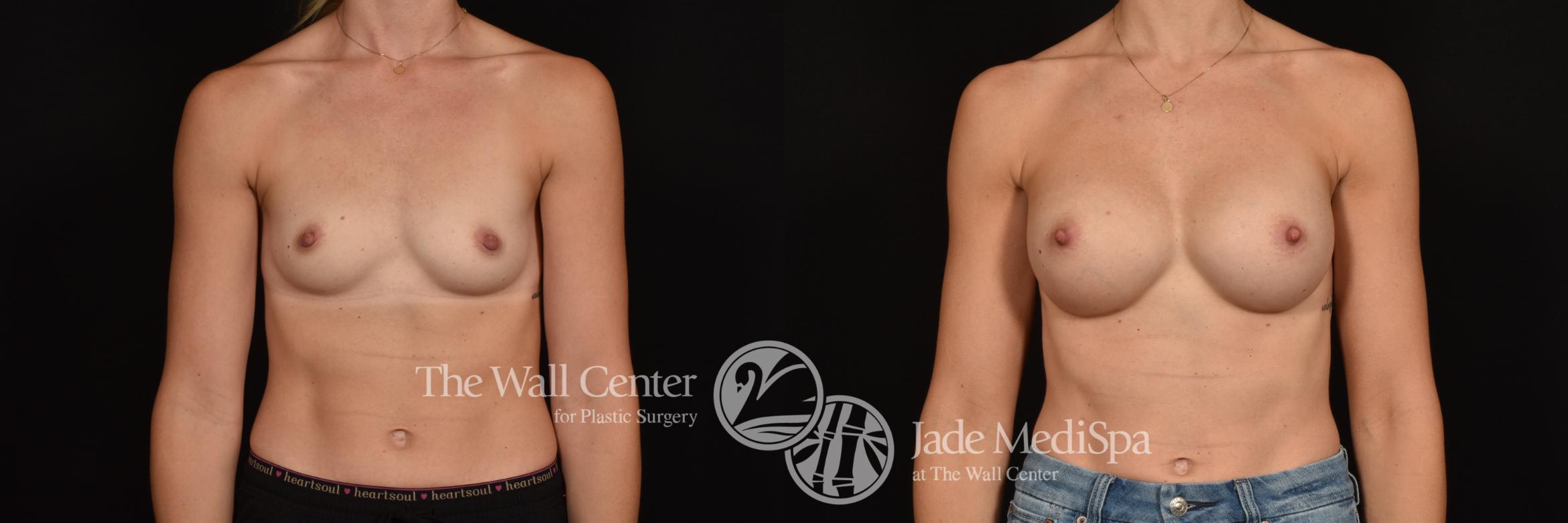Before & After Breast Augmentation Case 1084 Front View in Shreveport, LA
