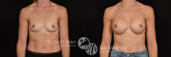 Before & After Breast Augmentation Case 1084 Front View in Shreveport, LA