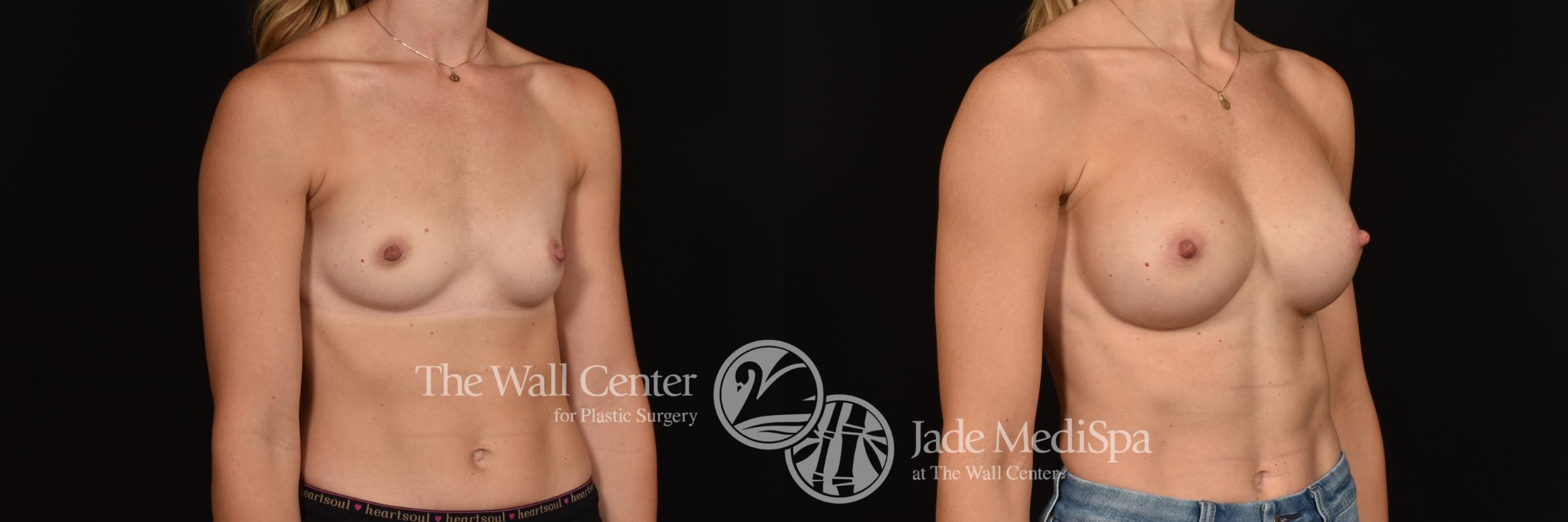 Before & After Breast Augmentation Case 1084 Right Oblique View in Shreveport, LA