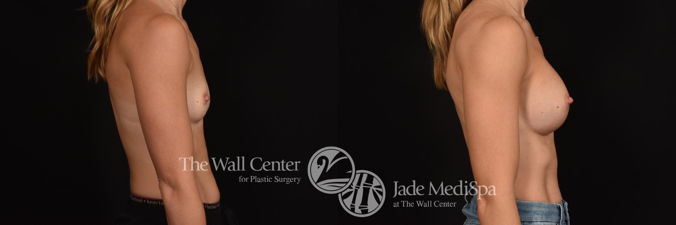 Before & After Breast Augmentation Case 1084 Right Side View in Shreveport, LA