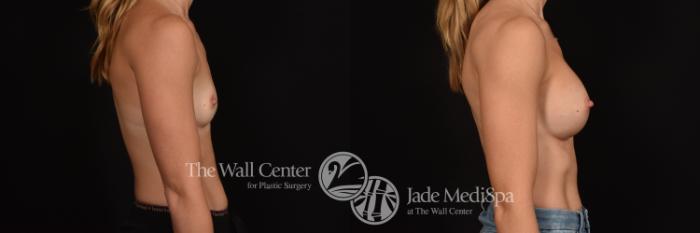 Before & After Breast Augmentation Case 1084 Right Side View in Shreveport, LA