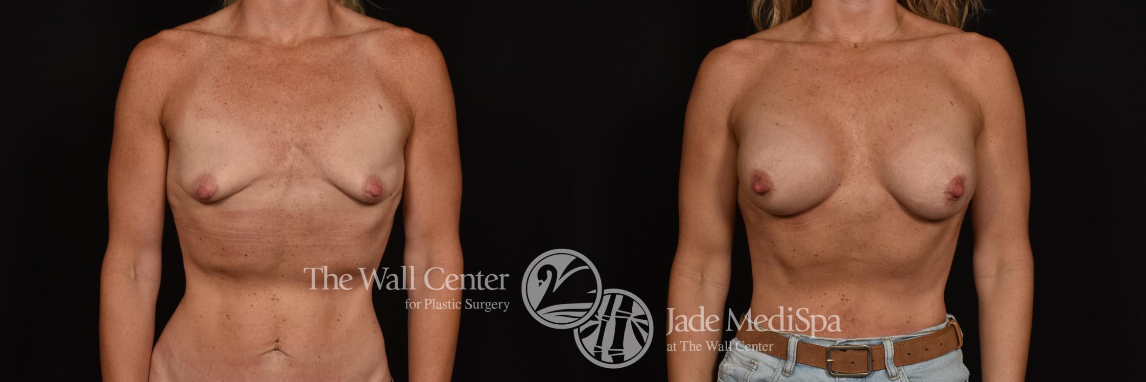 Before & After Breast Augmentation Case 1087 Front View in Shreveport, LA