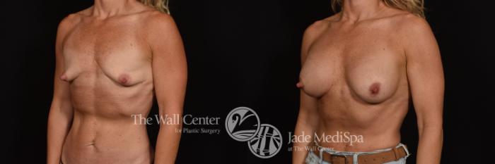 Before & After Breast Augmentation Case 1087 Left Oblique View in Shreveport, LA