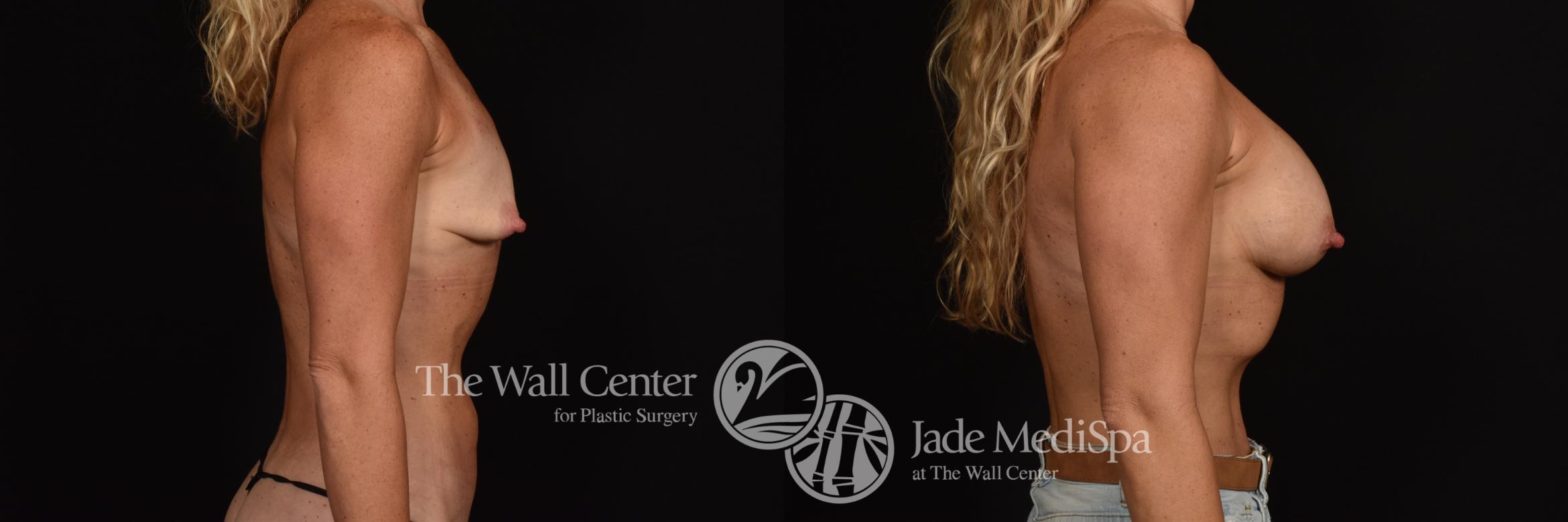 Before & After Breast Augmentation Case 1087 Right Side View in Shreveport, LA