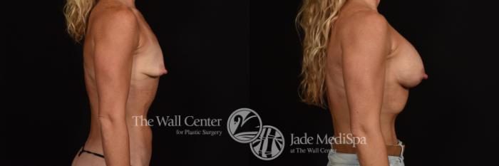 Before & After Breast Augmentation Case 1087 Right Side View in Shreveport, LA