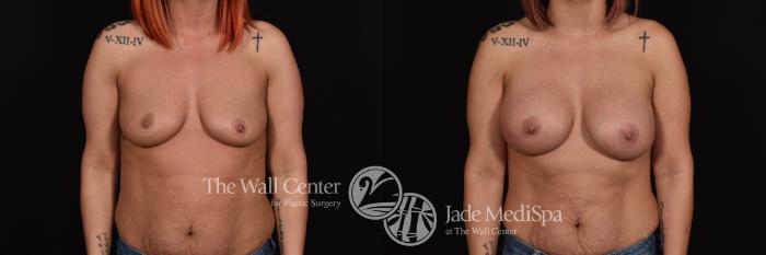 Before & After Breast Augmentation Case 1088 Front View in Shreveport, LA
