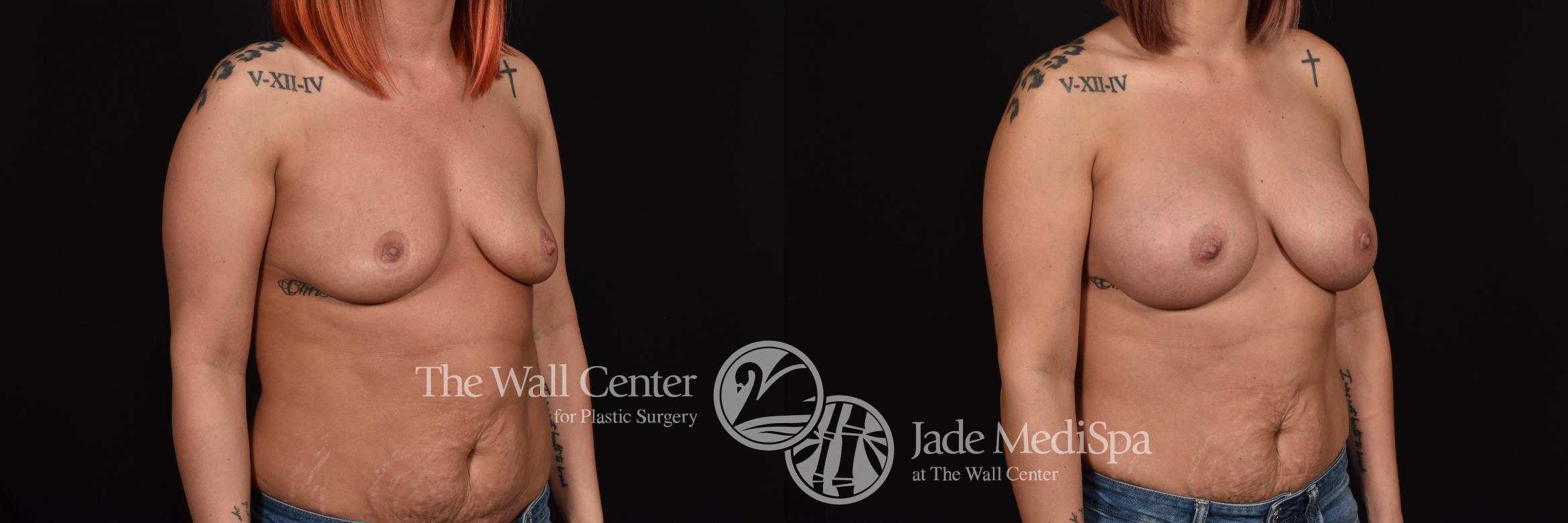 Before & After Breast Augmentation Case 1088 Right Oblique View in Shreveport, LA