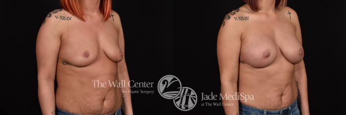 Before & After Breast Augmentation Case 1088 Right Oblique View in Shreveport, LA