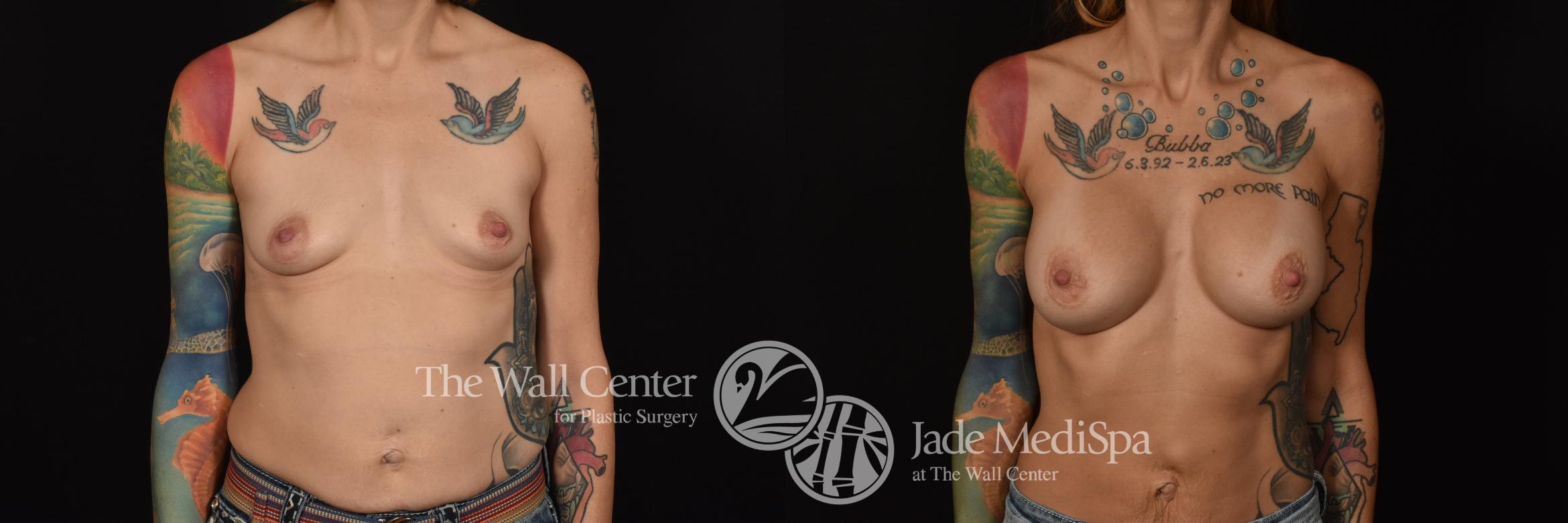 Before & After Breast Augmentation Case 1091 Front View in Shreveport, LA