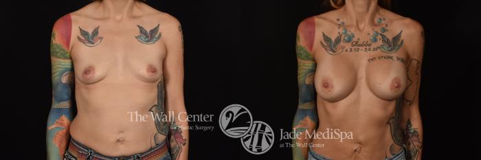 Before & After Breast Augmentation Case 1091 Front View in Shreveport, LA