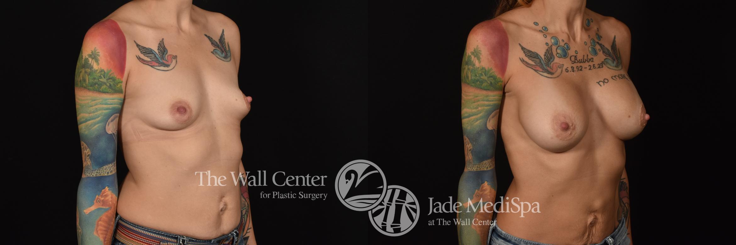 Before & After Breast Augmentation Case 1091 Right Oblique View in Shreveport, LA