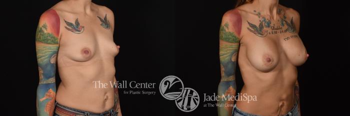 Before & After Breast Augmentation Case 1091 Right Oblique View in Shreveport, LA