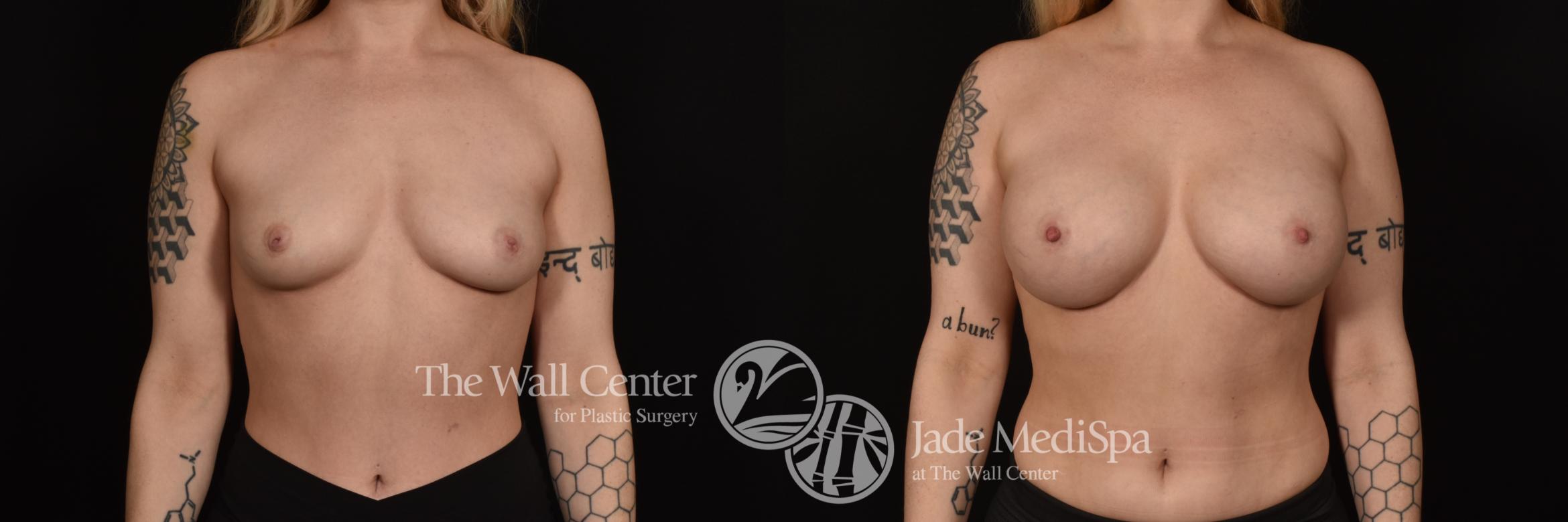 Before & After Breast Augmentation Case 1092 Front View in Shreveport, LA