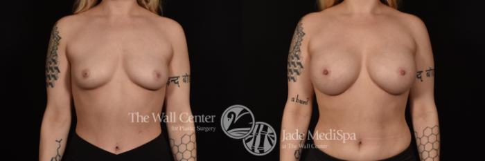 Before & After Breast Augmentation Case 1092 Front View in Shreveport, LA