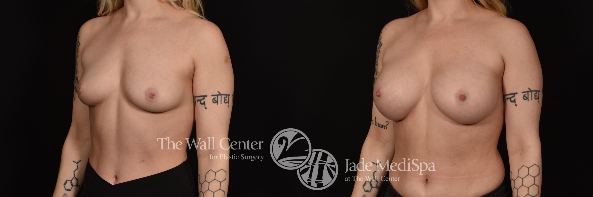 Before & After Breast Augmentation Case 1092 Left Oblique View in Shreveport, LA