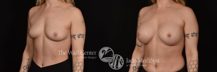 Before & After Breast Augmentation Case 1092 Left Oblique View in Shreveport, LA